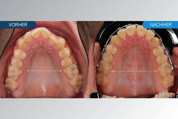 magazin mse expander california smile kieferorthopädie münchen