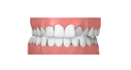 crossbite