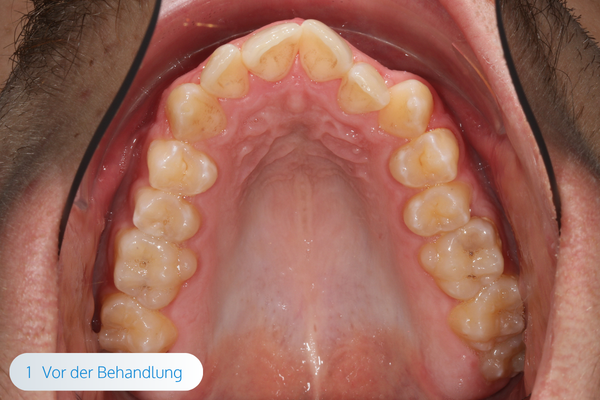 magazin-mse-expander-02-kieferorthopaede-muenchen-maximilian-schreiner-californiasmile.png