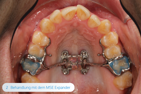magazin-mse-expander-03-kieferorthopaede-muenchen-maximilian-schreiner-californiasmile.png