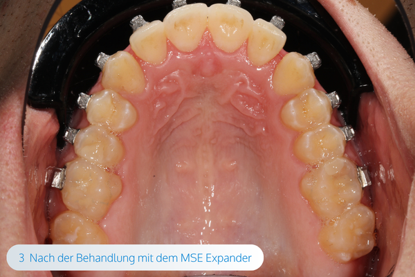 magazin-mse-expander-04-kieferorthopaede-muenchen-maximilian-schreiner-californiasmile.png